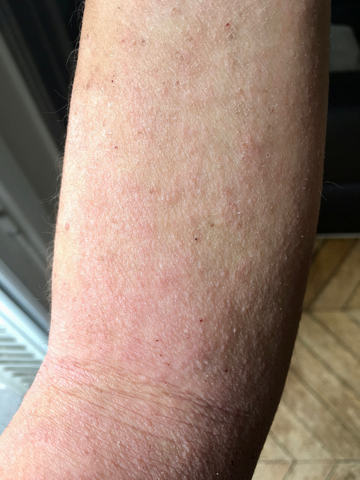 Eczéma rouge et sec sur l'avant-bras, stade 2