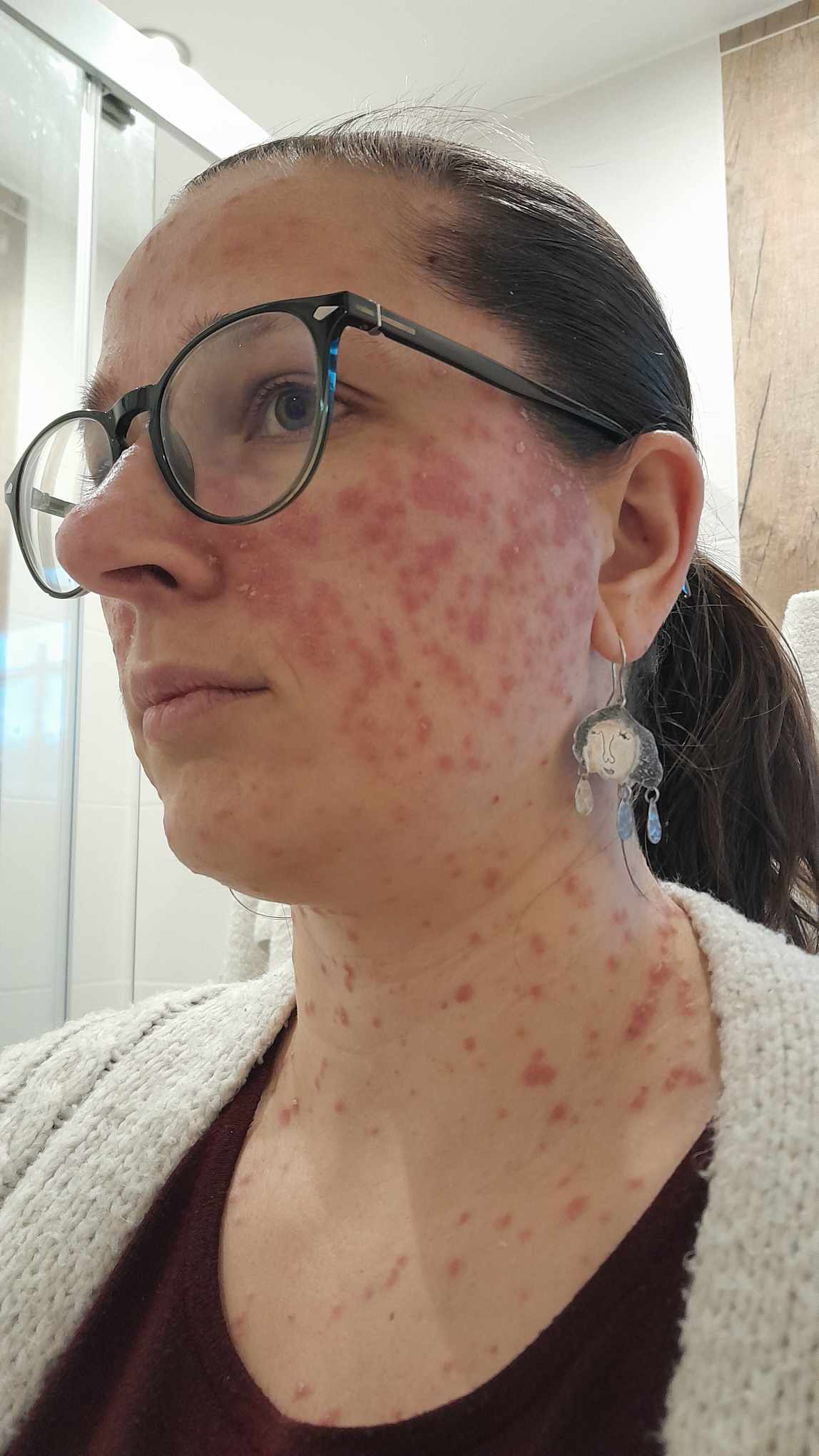 Visage femme peau blanche avec acné