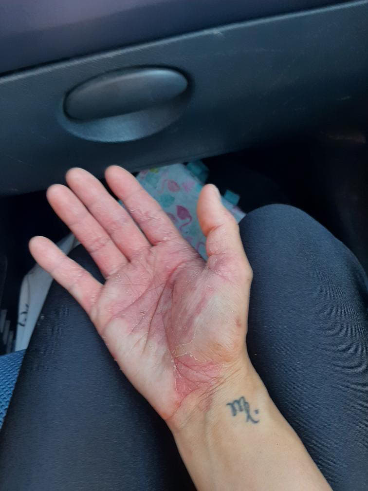 Peau de Justine avant Pomad