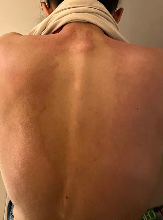 Peau de Charlotte avant Pomad