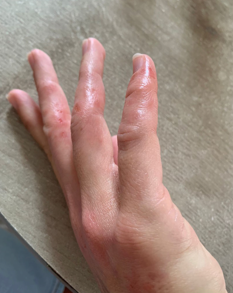 Peau de Margaux avant Pomad