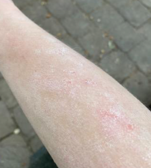 Peau de Carolie après Pomad