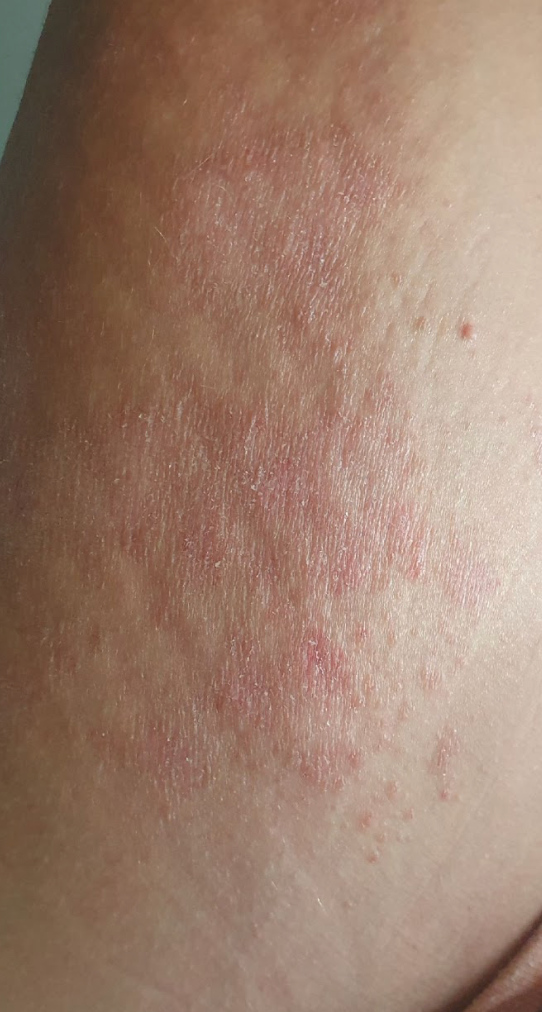 Peau de Lauriane avant Pomad