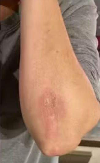 Peau de Carole avant Pomad