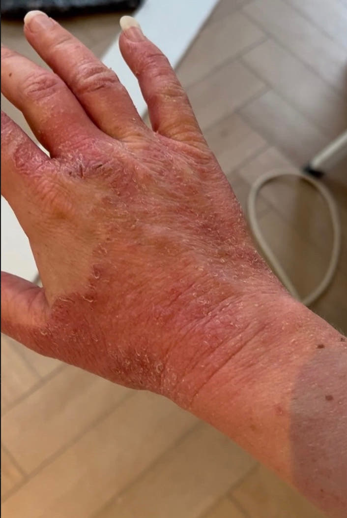 Peau de Juline avant Pomad