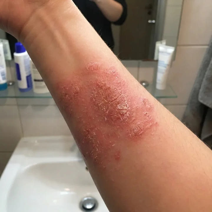 Mon avant-bras au départ, photographié un soir dans ma salle de bain : plaque rouge et sèche