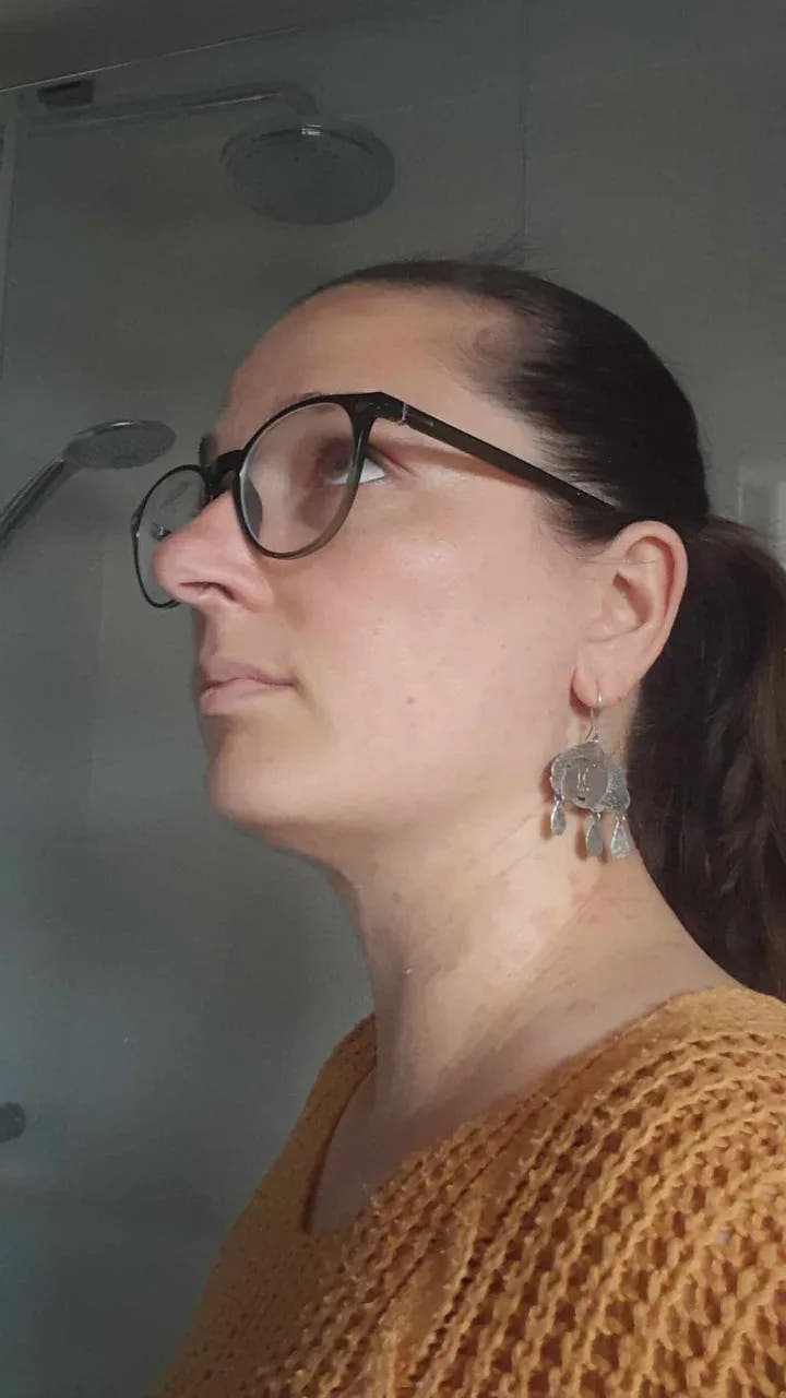Le même visage, peau nettement apaisée, après la Cure