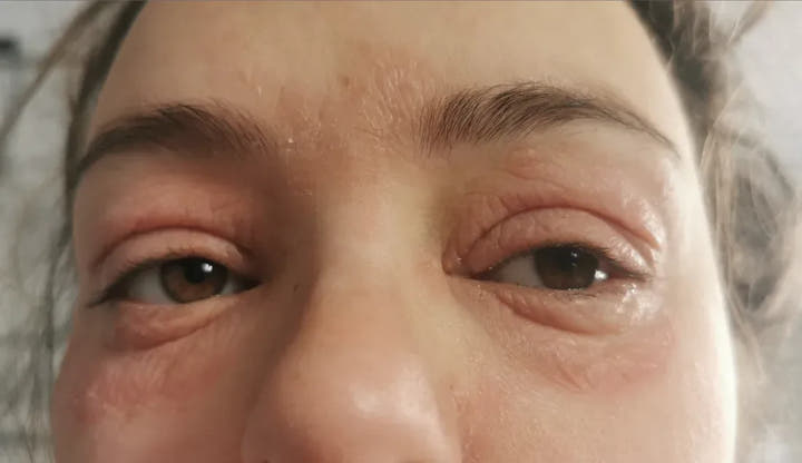 Contour des yeux irrité et gonflé, avant la Cure