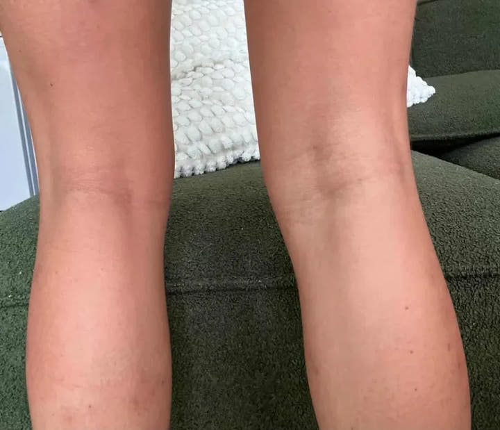 Les jambes de Camille après la Cure, peau apaisée