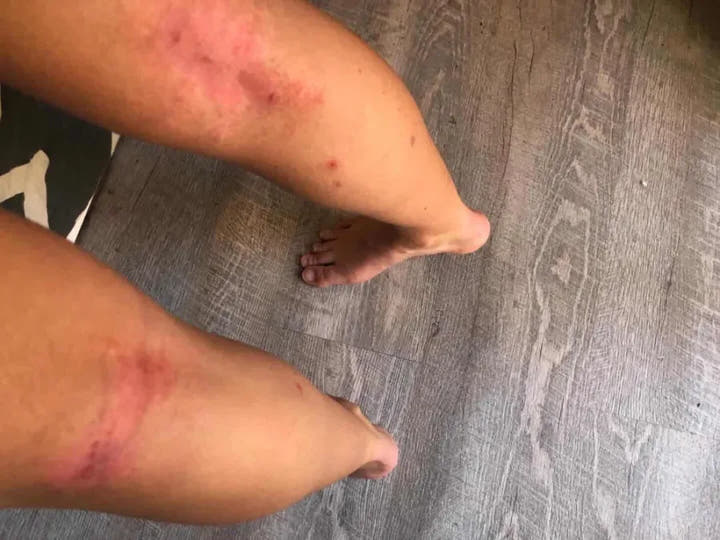 Les jambes de Camille avec plaques rouges sur les tibias et les genoux, avant la Cure